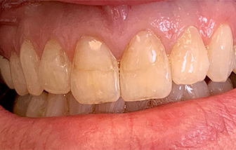 Discolored and damaged teeth before dental treatment